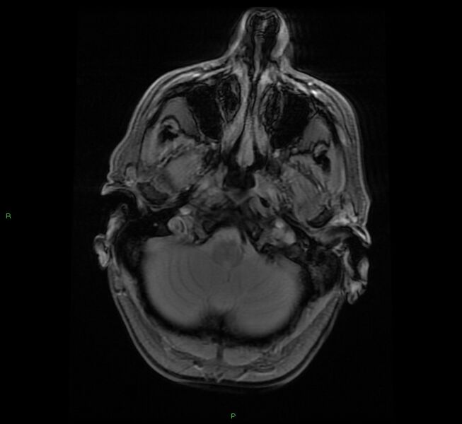 File:Cerebral amyloid angiopathy-associated lobar intracerebral hemorrhage (Radiopaedia 58529-65684 Axial Gradient Echo 4).jpg