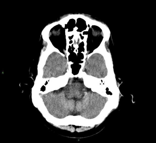 File:Cerebral amyloid angiopathy-associated lobar intracerebral hemorrhage (Radiopaedia 58529-65686 Axial non-contrast 5).jpg