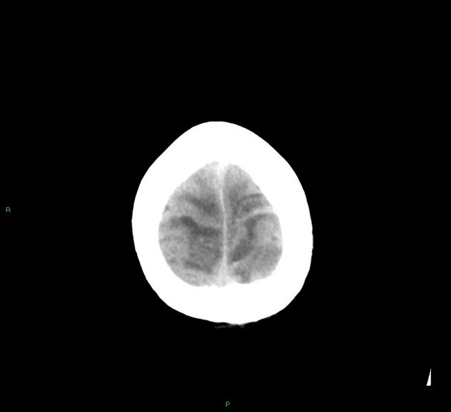 File:Cerebral amyloid angiopathy-associated lobar intracerebral hemorrhage (Radiopaedia 58529-65687 Axial non-contrast 7).jpg