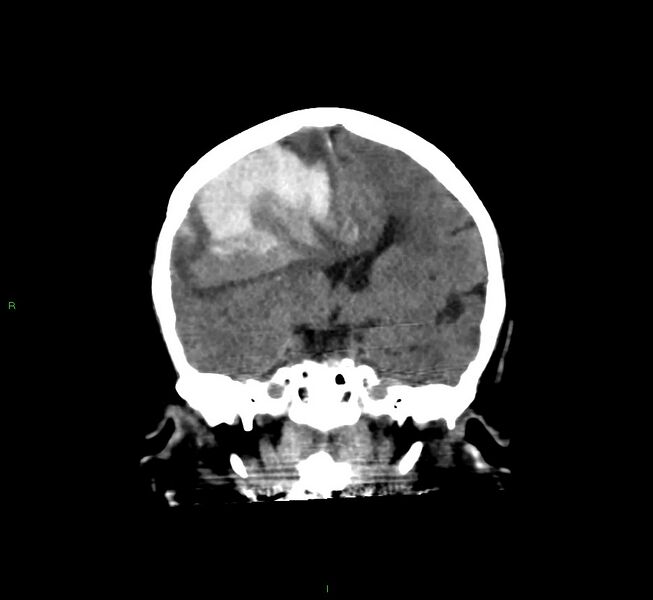 File:Cerebral amyloid angiopathy-associated lobar intracerebral hemorrhage (Radiopaedia 58560-65723 Coronal non-contrast 41).jpg