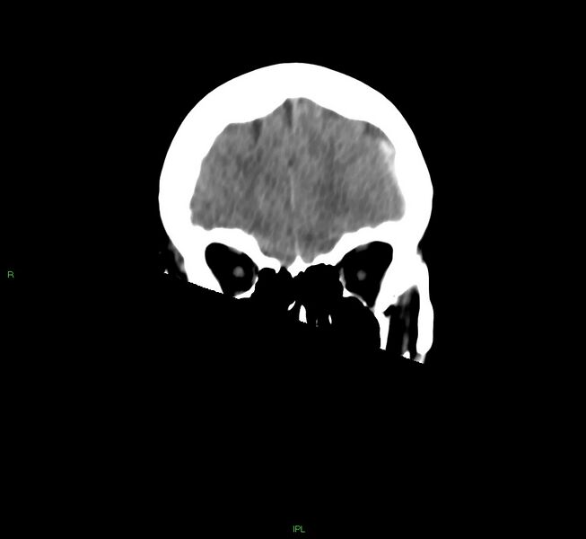 File:Cerebral amyloid angiopathy-associated lobar intracerebral hemorrhage (Radiopaedia 58754-65975 Coronal non-contrast 49).jpg