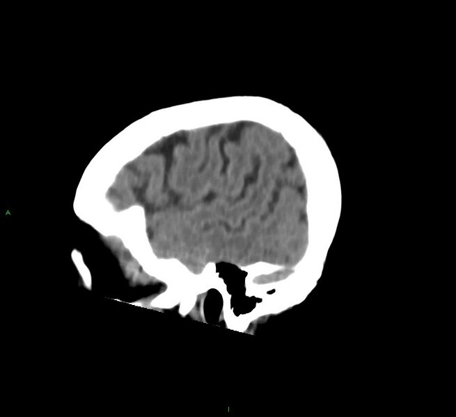 File:Cerebral amyloid angiopathy-associated lobar intracerebral hemorrhage (Radiopaedia 58757-65978 C 10).jpg