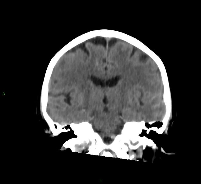 File:Cerebral amyloid angiopathy-associated lobar intracerebral hemorrhage (Radiopaedia 58757-65978 Coronal non-contrast 35).jpg