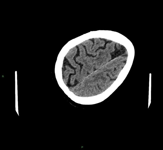 File:Cerebral amyloid angiopathy-associated lobar intracerebral hemorrhage (Radiopaedia 58757-65979 Axial non-contrast 120).jpg