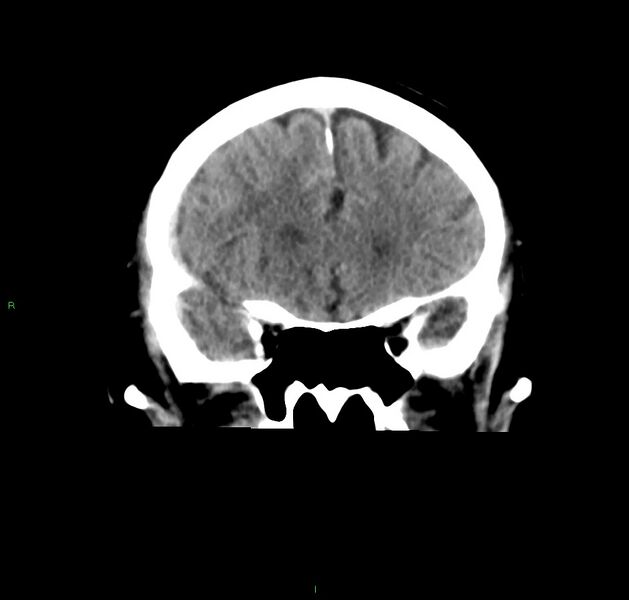 File:Cerebral amyloid angiopathy-associated lobar intracerebral hemorrhage (Radiopaedia 59356-66716 Coronal non-contrast 46).jpg