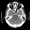 Cerebral and orbital tuberculomas (Radiopaedia 13308-13310 Axial non-contrast 8).jpg