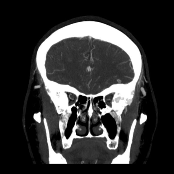 File:Cerebral arteriovenous malformation (Radiopaedia 43729-47189 C 11).jpg