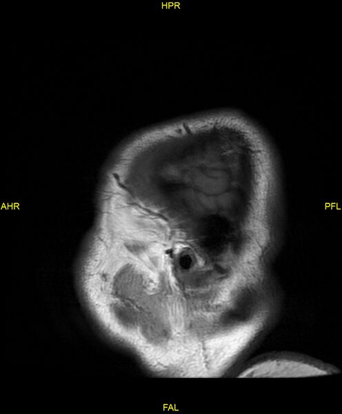 File:Cerebral autosomal dominant arteriopathy with subcortical infarcts and leukoencephalopathy (CADASIL) (Radiopaedia 86108-102054 Sagittal T1 2).jpg