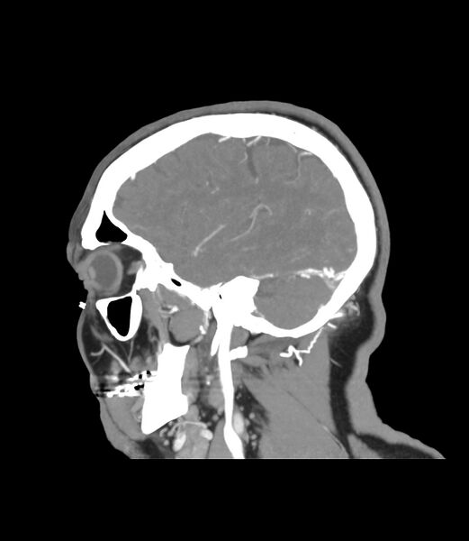 File:Cerebral dural venous sinus thrombosis (Radiopaedia 86514-102576 C 46).jpg