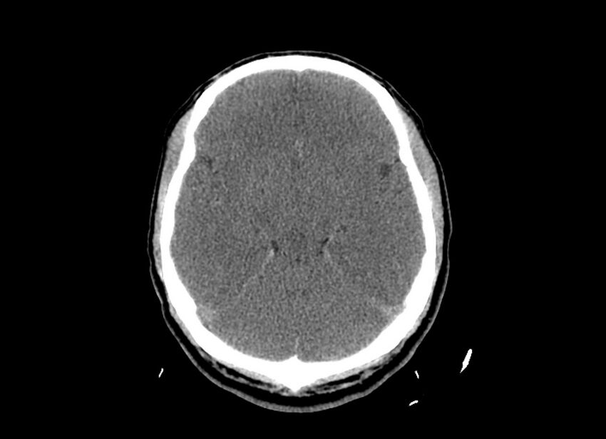 Cerebral edema (Radiopaedia 82519-96661 Axial non-contrast 33).jpg