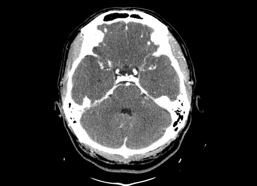 Cerebral edema (Radiopaedia 82519-96661 B 41).jpg
