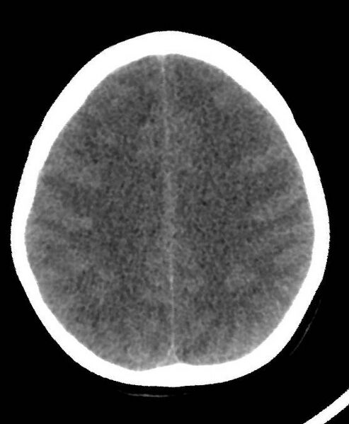 File:Cerebral edema due to severe hyponatremia (Radiopaedia 89826-106937 Axial non-contrast 64).jpg