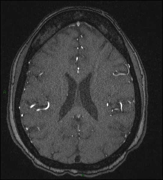 File:Cerebral fat embolism (Radiopaedia 35022-36525 Axial TOF 131).jpg