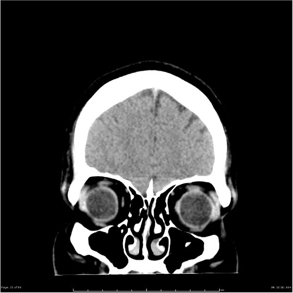File:Cerebral hemorrhage secondary to arteriovenous malformation (Radiopaedia 33497-34561 Coronal non-contrast 2).jpg