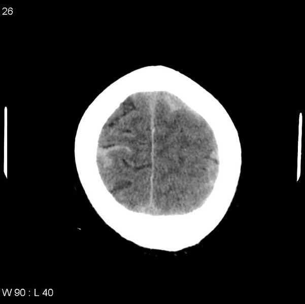 File:Cerebral hemorrhagic contusion with subdural and subarachnoid hemorrhage (Radiopaedia 10680-19197 Axial non-contrast 22).jpg