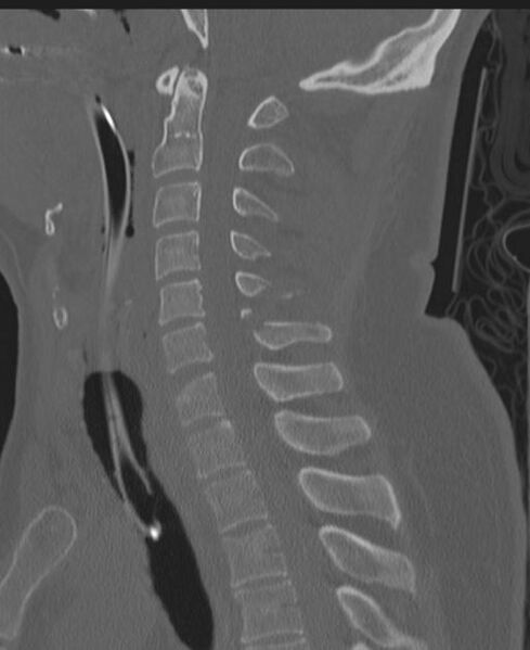 File:Cerebral hemorrhagic contusions and cervical spine fractures (Radiopaedia 32865-33841 Sagittal bone window 52).jpg