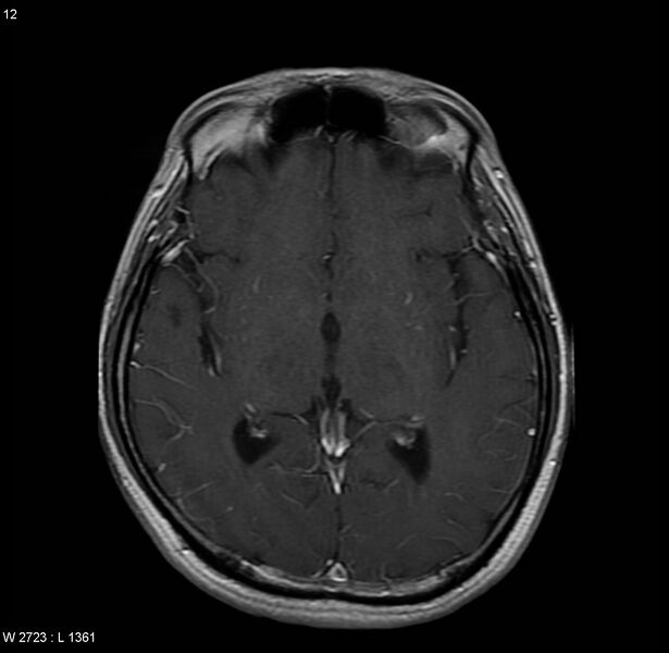 File:Cerebral vasculitis (Radiopaedia 5131-6923 Axial T1 C+ 1).jpg