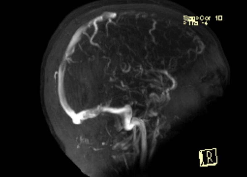 File:Cerebral venous infarct (Radiopaedia 53627-59723 3D MRV 19).jpg