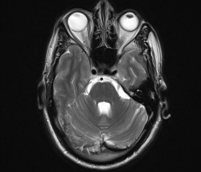 File:Cerebral venous thrombosis (Radiopaedia 71207-81504 Axial T2 9).jpg