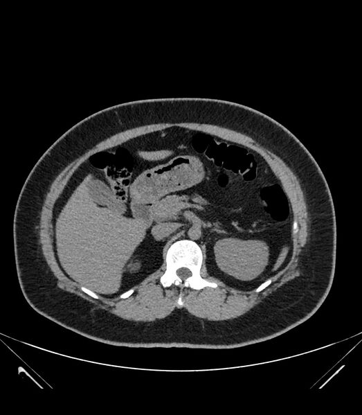 File:Cervical aortic arch with coarctation and aneurysms (Radiopaedia 44035-47552 Axial non-contrast 51).jpg