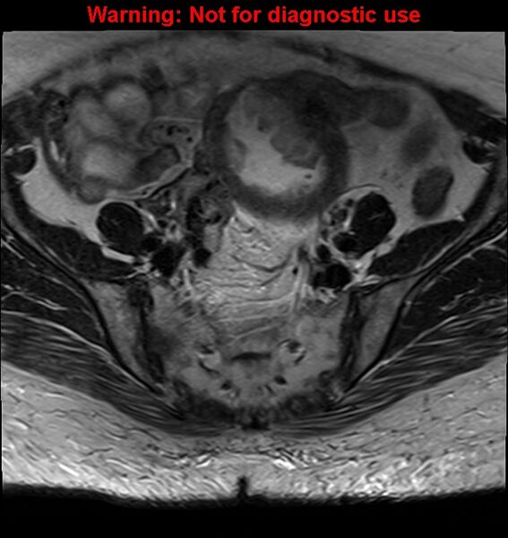 File:Cervical cancer (Radiopaedia 24151-24410 Axial T2 7).jpg