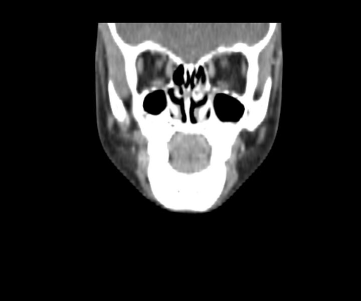 File:Cervical cystic lymphangioma (Radiopaedia 63655-72332 Coronal + contrast 10).jpg