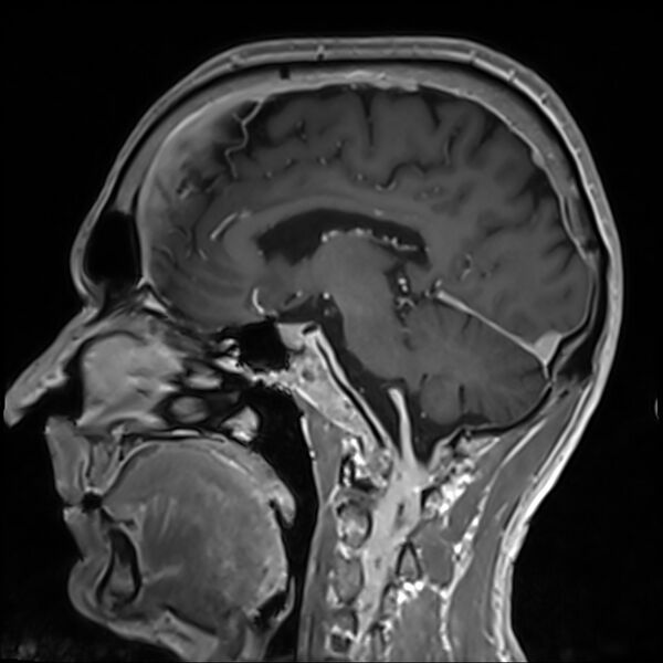 File:Cervical dural CSF leak on MRI and CT treated by blood patch (Radiopaedia 49748-54995 G 49).jpg