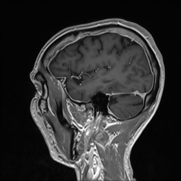 File:Cervical dural CSF leak on MRI and CT treated by blood patch (Radiopaedia 49748-54995 G 98).jpg