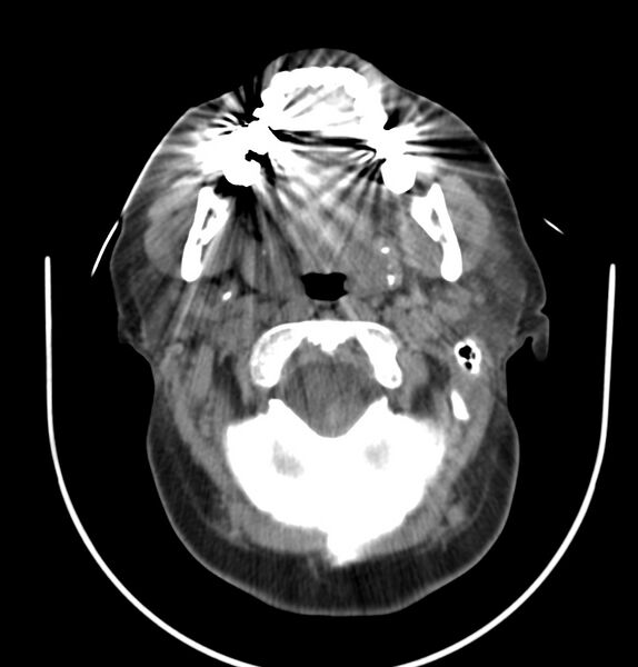 File:Cervical lymphadenopathy- cause unknown (Radiopaedia 22420-22457 non-contrast 33).jpg
