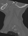Cervical spine ACDF loosening (Radiopaedia 48998-54071 Sagittal bone window 19).png