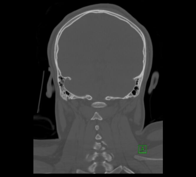 File:Cervical spine fracture - hyperflexion injury (Radiopaedia 66184-75364 Coronal bone window 13).jpg