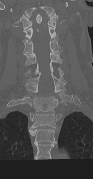 File:Cervical spine fracture in the setting of ankylosis (Radiopaedia 37038-38715 Coronal bone window 37).png