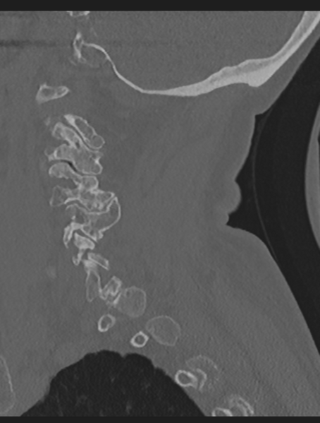 File:Cervical spondylolysis (Radiopaedia 49616-54811 Sagittal bone window 20).png