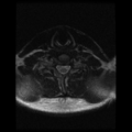 Cervical vertebrae metastasis (Radiopaedia 78814-91667 Axial T2 3).png