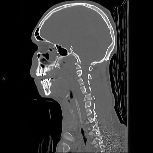 File:Cervical vertebral burst fracture (Radiopaedia 37420-39258 Sagittal bone window 9).jpg