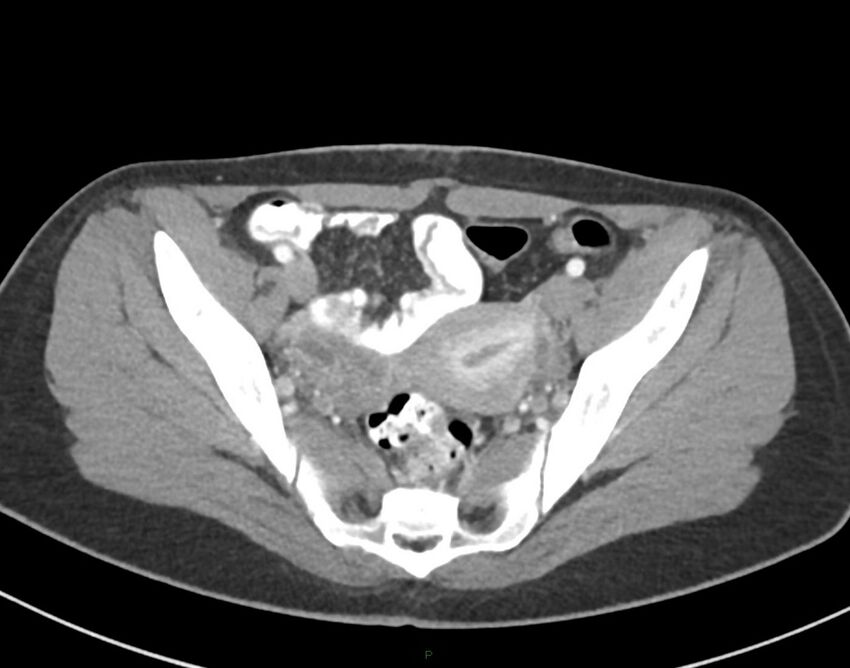 Cesarean scar endometriosis (Radiopaedia 82925-97262 A 71).jpg