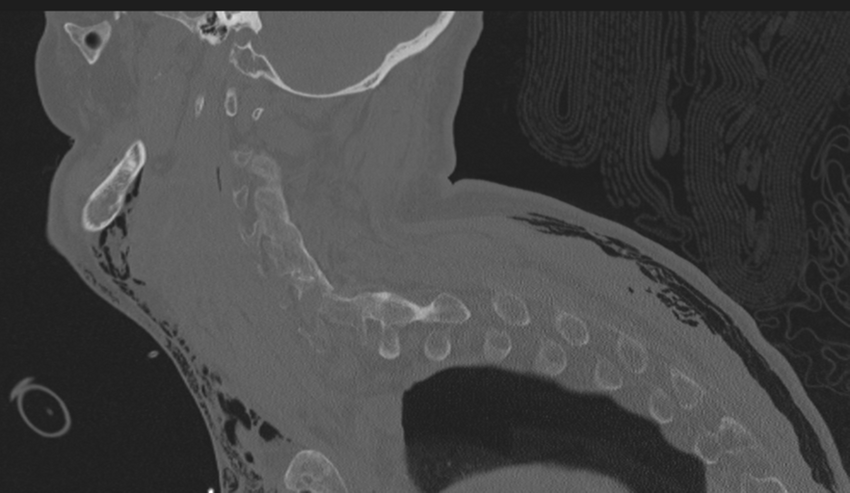 Chalk stick fracture (Radiopaedia 57948-64928 Sagittal bone window 14).png