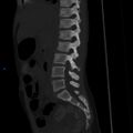 Chance fracture with duodenal and pancreatic lacerations (Radiopaedia 43477-50042 Sagittal bone window 15).jpg