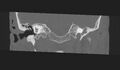 Cholesteatoma (Radiopaedia 10742-11203 Coronal bone window 8).jpg
