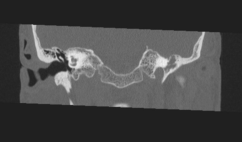 File:Cholesteatoma (Radiopaedia 10742-11203 Coronal bone window 8).jpg