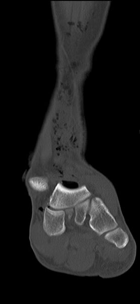 File:Chopart fracture (Radiopaedia 35347-36851 Coronal bone window 46).jpg