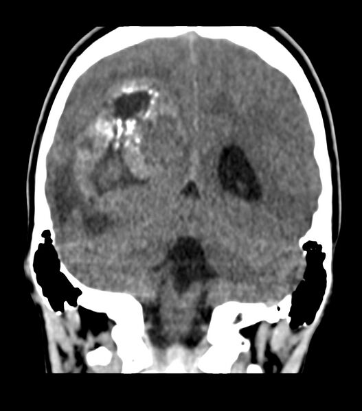 File:Choroid plexus carcinoma (Radiopaedia 91013-108552 Coronal non-contrast 60).jpg