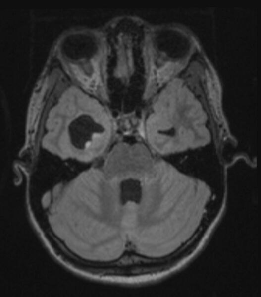 File:Choroid plexus carcinoma (Radiopaedia 91013-108553 Axial FLAIR C+ 103).jpg