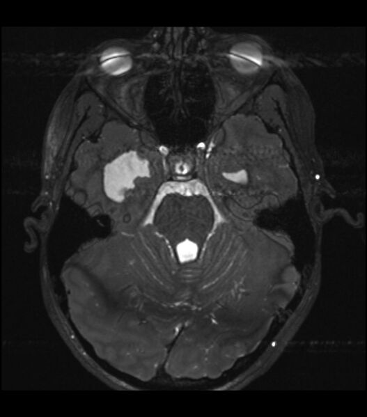 File:Choroid plexus carcinoma (Radiopaedia 91013-108553 Axial T2 CISS 4).jpg