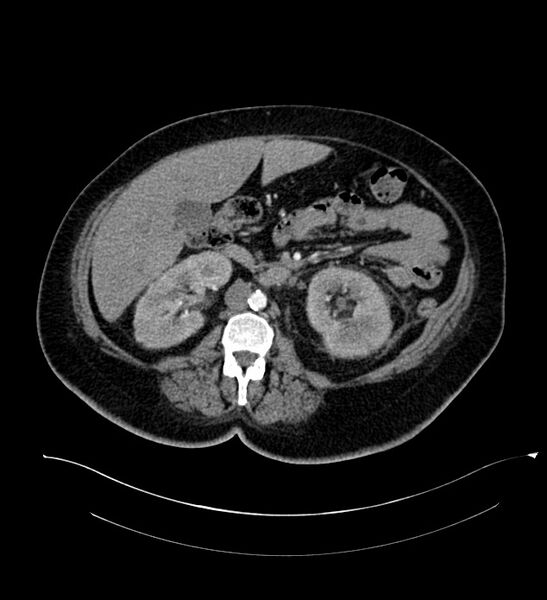 File:Chromophobe renal cell carcinoma (Radiopaedia 84239-99519 B 56).jpg