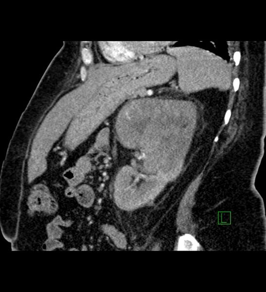 File:Chromophobe renal cell carcinoma (Radiopaedia 84239-99519 D 41).jpg