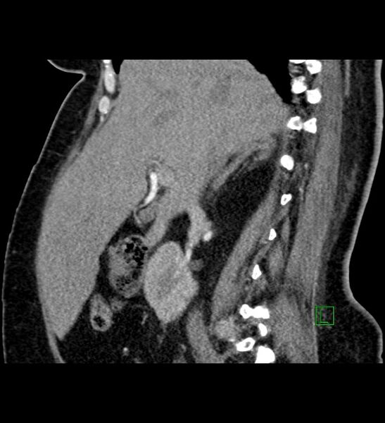 File:Chromophobe renal cell carcinoma (Radiopaedia 84239-99519 D 73).jpg