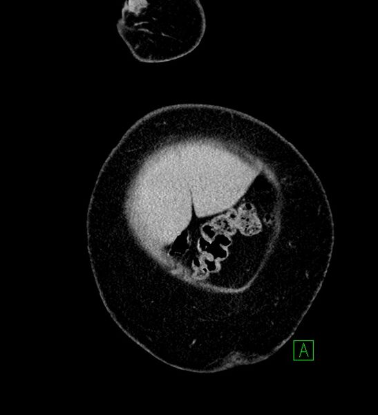 File:Chromophobe renal cell carcinoma (Radiopaedia 84239-99519 F 6).jpg