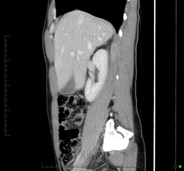 File:Chronic abscess due to "dropped" appendicoliths following appendectomy for perforated appendix (Radiopaedia 58805-66344 D 38).jpg