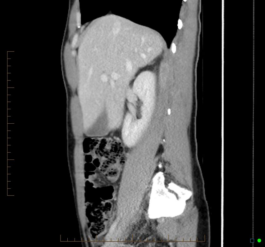 Chronic abscess due to "dropped" appendicoliths following appendectomy for perforated appendix (Radiopaedia 58805-66344 D 38).jpg